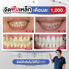 จัดฟันโลหะ (Bracket Brace)