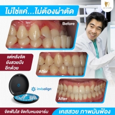 จัดฟันแบบใสหมออาร์มประสบการณ์จัดฟันใส10ปี