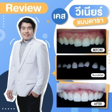 วีเนียร์เซรามิก (ไม่ใช่คอมโพสิต)  8ซี่ จากปกติซี่ละ 12000 บาท เหลือ 69900 รวม 8ซี่ 