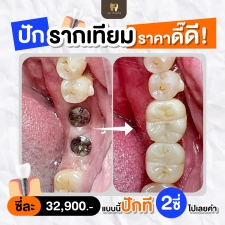 รากฟันเทียม 32900 บาท รวมครอบฟันเซรามิกแบบแพงแล้วด้วย