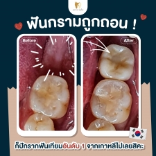 คลิกเพื่อดูเคสรากฟันเทียม